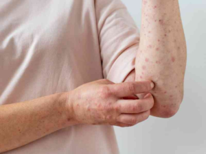 Salud confirma dos casos de viruela símica en Costa Rica